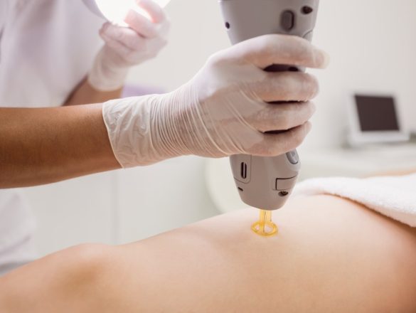 le guide pour comprendre l'épilation laser